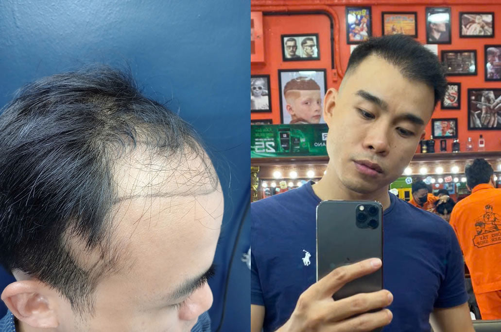 From Consultation to Confidence: A Patient’s Hair Transplant Journey