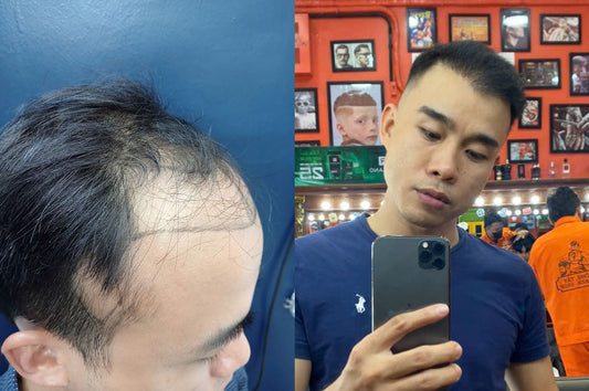 From Consultation to Confidence: A Patient’s Hair Transplant Journey
