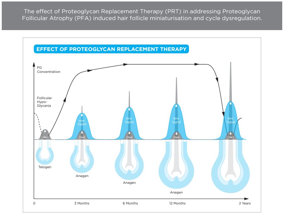 Nourkrin® 生发+ 诊所内疗程 – 蛋白聚糖替代疗法 (PRT) 治疗脱发