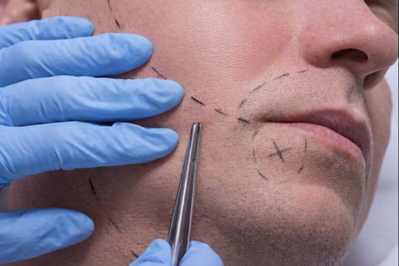 Beard Transplant in Vietnam