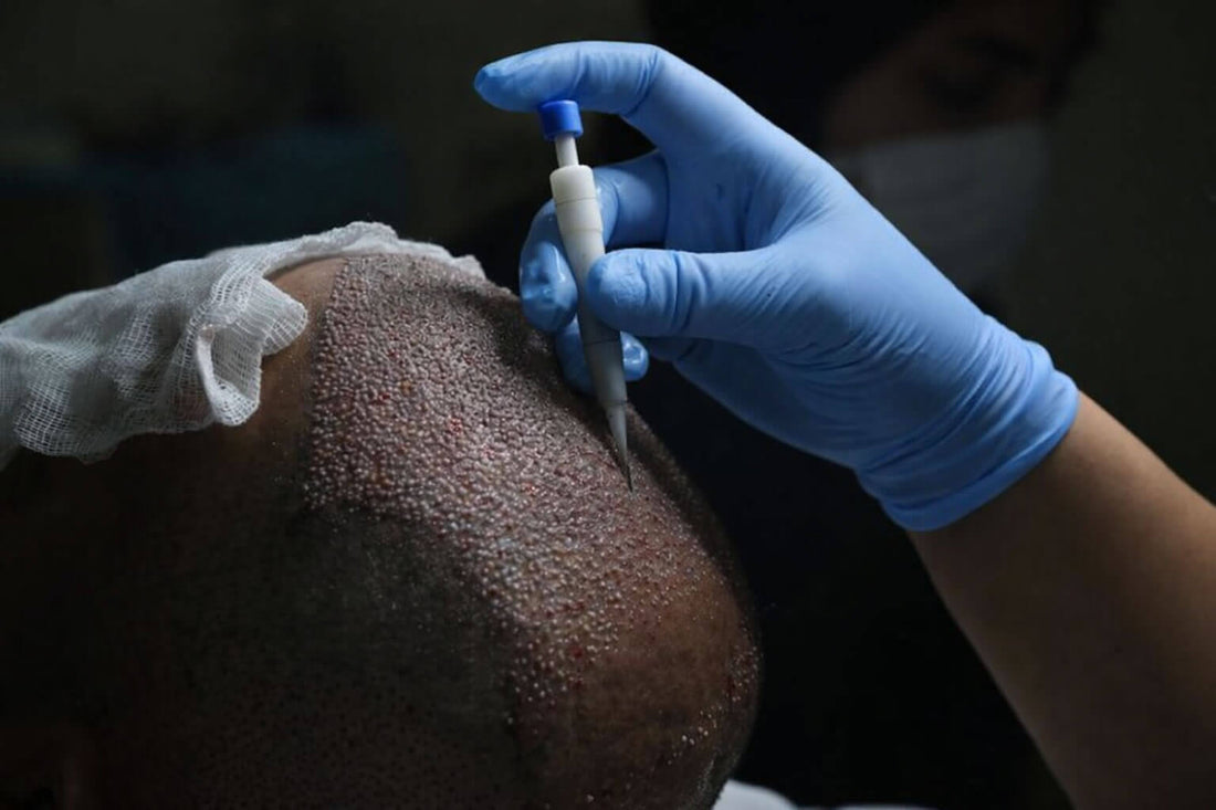 Direct Hair Implantation (DHI): The Most Advanced Hair Transplant Method in 2025