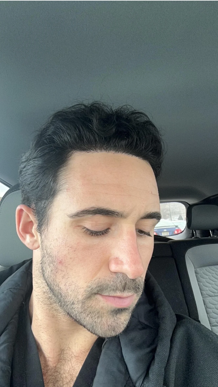 After - Month 9