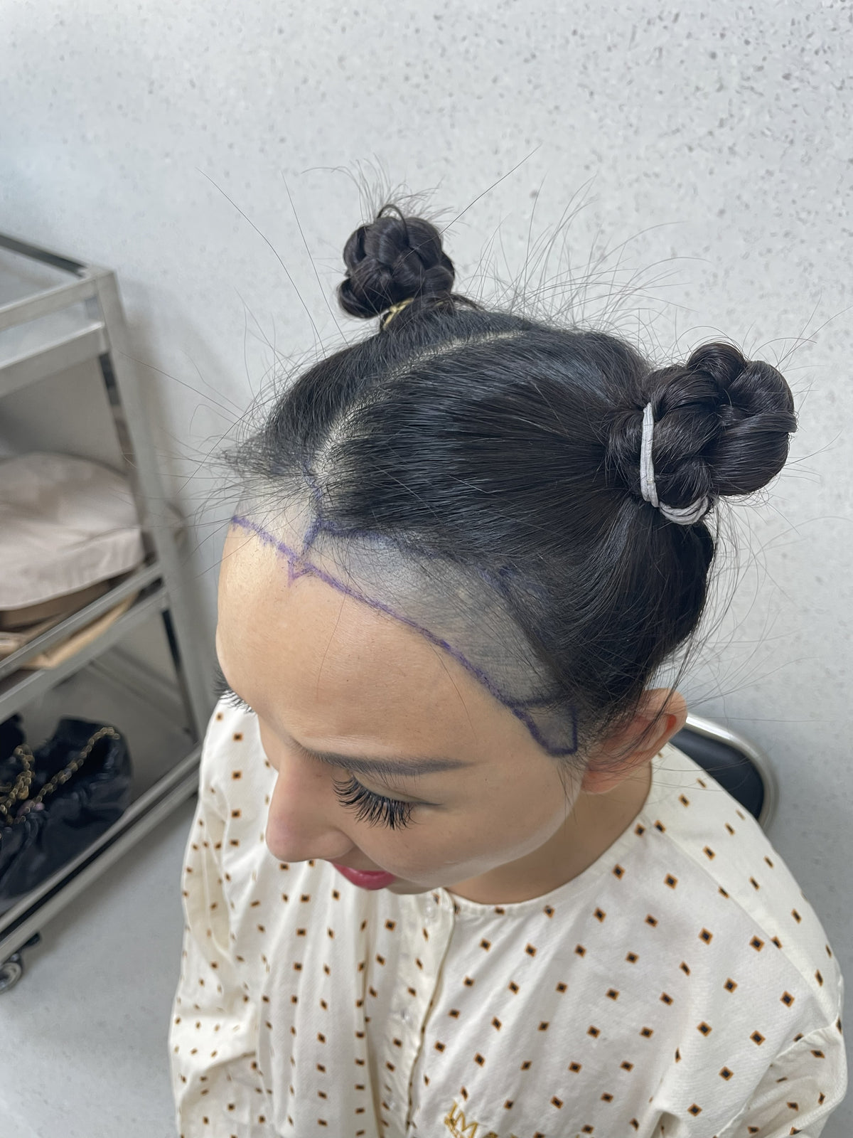 Before treatment
