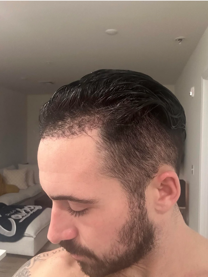 Before - Month 1