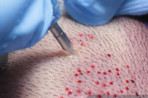 FUE Hair Transplant